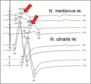 Elektrodiagnostik bei Porphyrie-Polyneuropathie. Axonale Schädigung des N. medianus rechts. Amplituden der motorischen Summenpotentiale sind erniedrigt, die motorische Nervenleitgeschwindigkeit ist normal.
