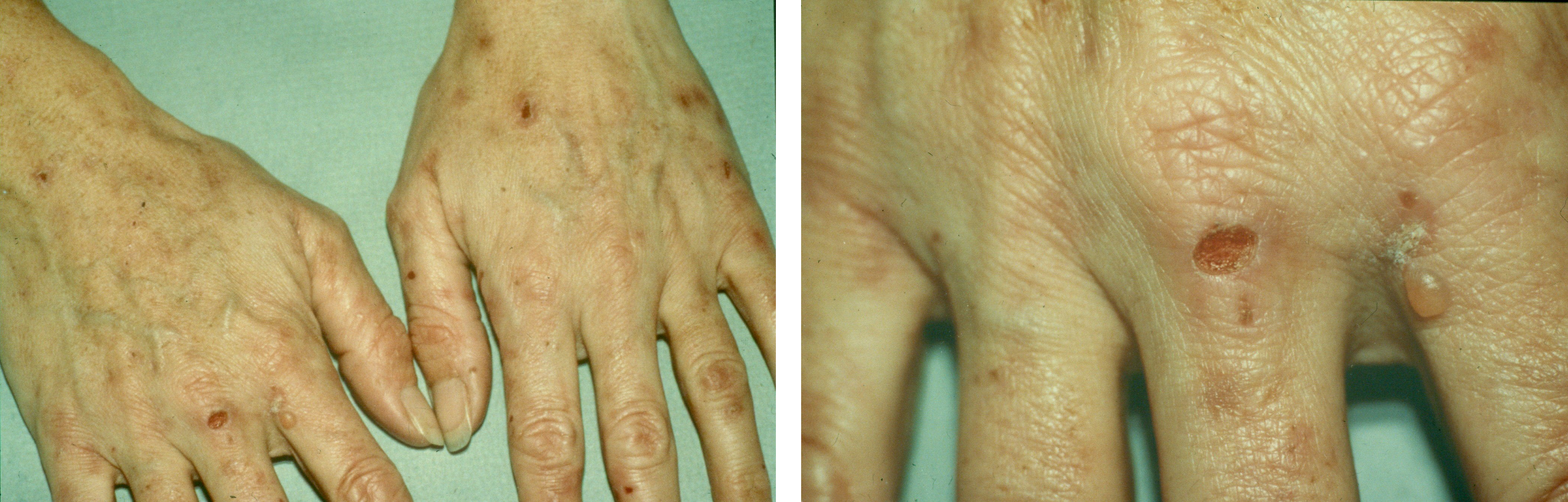 Hände einer Patientin mit Porphyria variegata: Blasen, Erosionen, Krusten und Narben sind typisch bei dieser Form der akuten Porphyrie.
